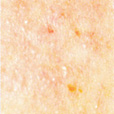 Cheek Capillaries After