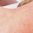 Skin Tag After