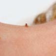 Skin Tag Before
